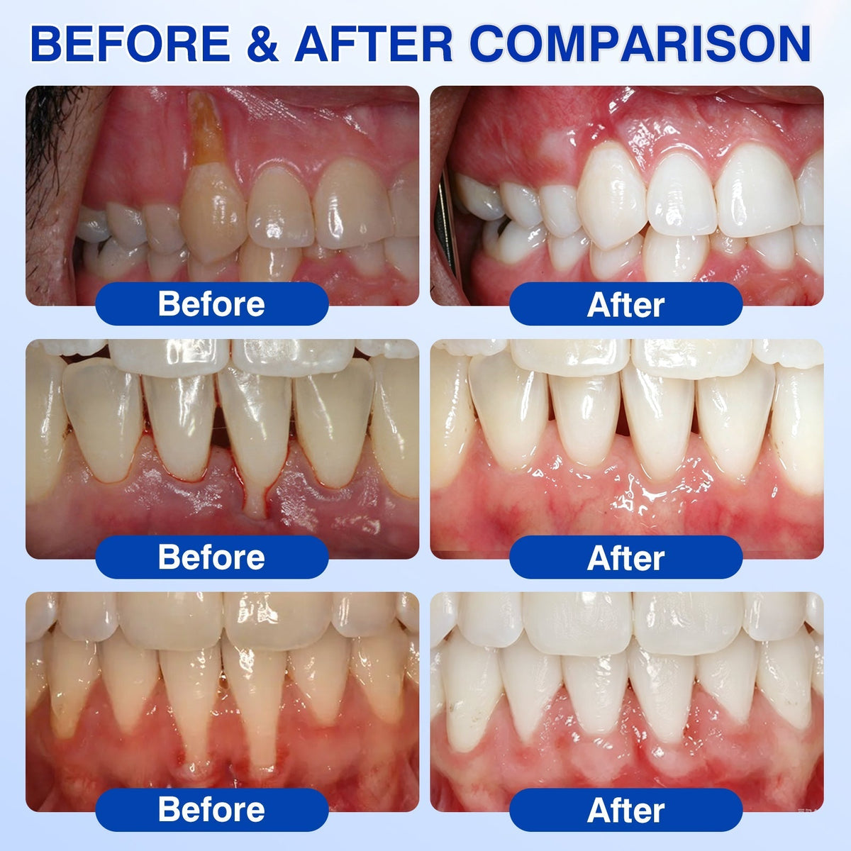 🦷 Periodontal RepairGel - Targeted Gumline Supportfor Plaque, Cavities, PeriodontalConcerns, Bad Breath & WeakTeeth Precision Leave-On OralCare Formula